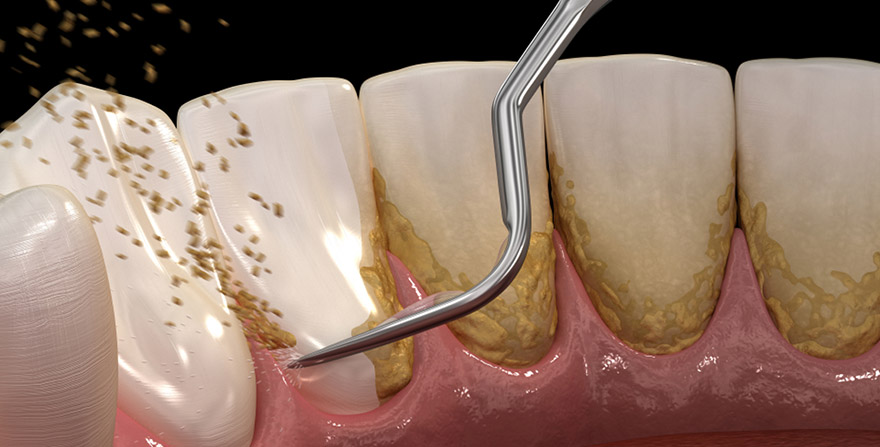 Qué es la limpieza dental con ultrasonidos?